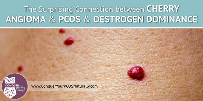 The Surprising Connection Between Cherry Angioma and PCOS and Oestrogen Dominance